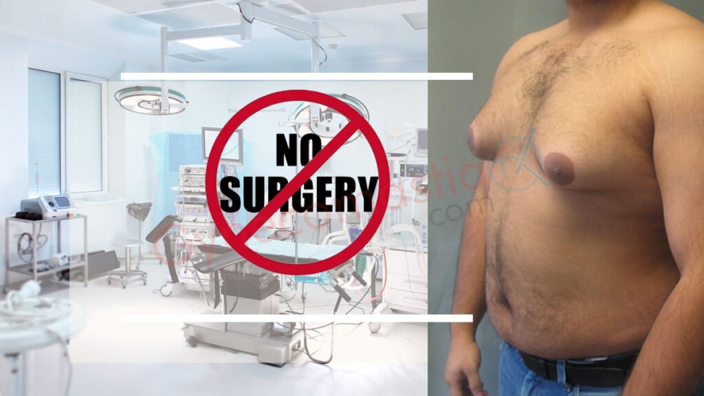 Cure Gynecomastia Without Surgery