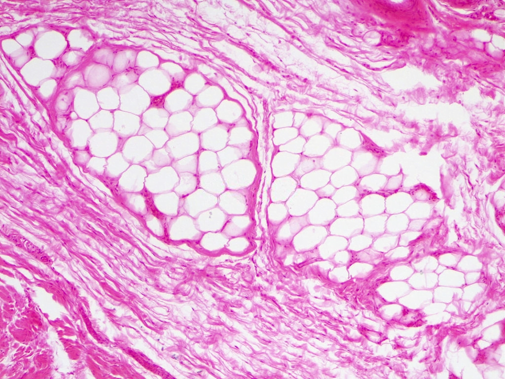 Fatty Tissues in the Male Chest